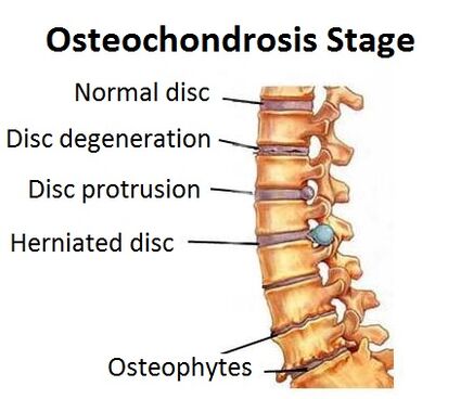 Osteochondrosis steps