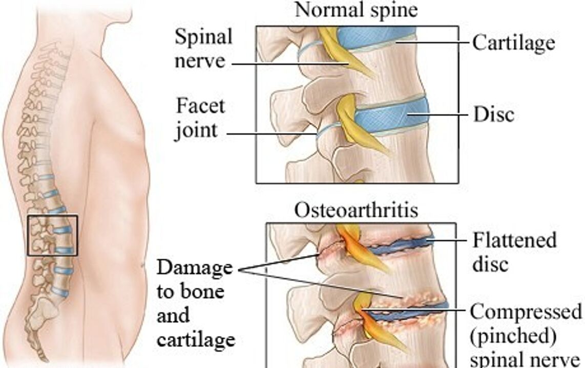 The difference between a healthy disc and an osteochondrosis disc
