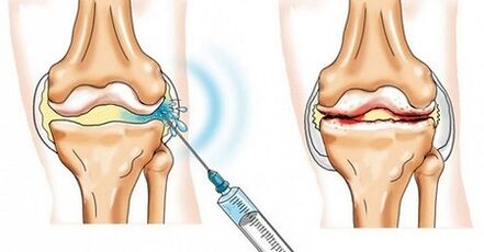 How to treat osteoarthritis on the knee joint