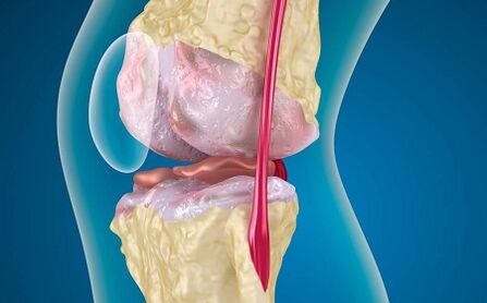 The reasons for the development of osteoarthritis of the knee joint